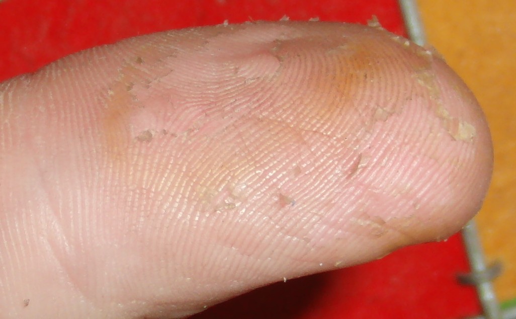 hno3_thumb_healing.jpg hno3_thumb_healing.jpg
